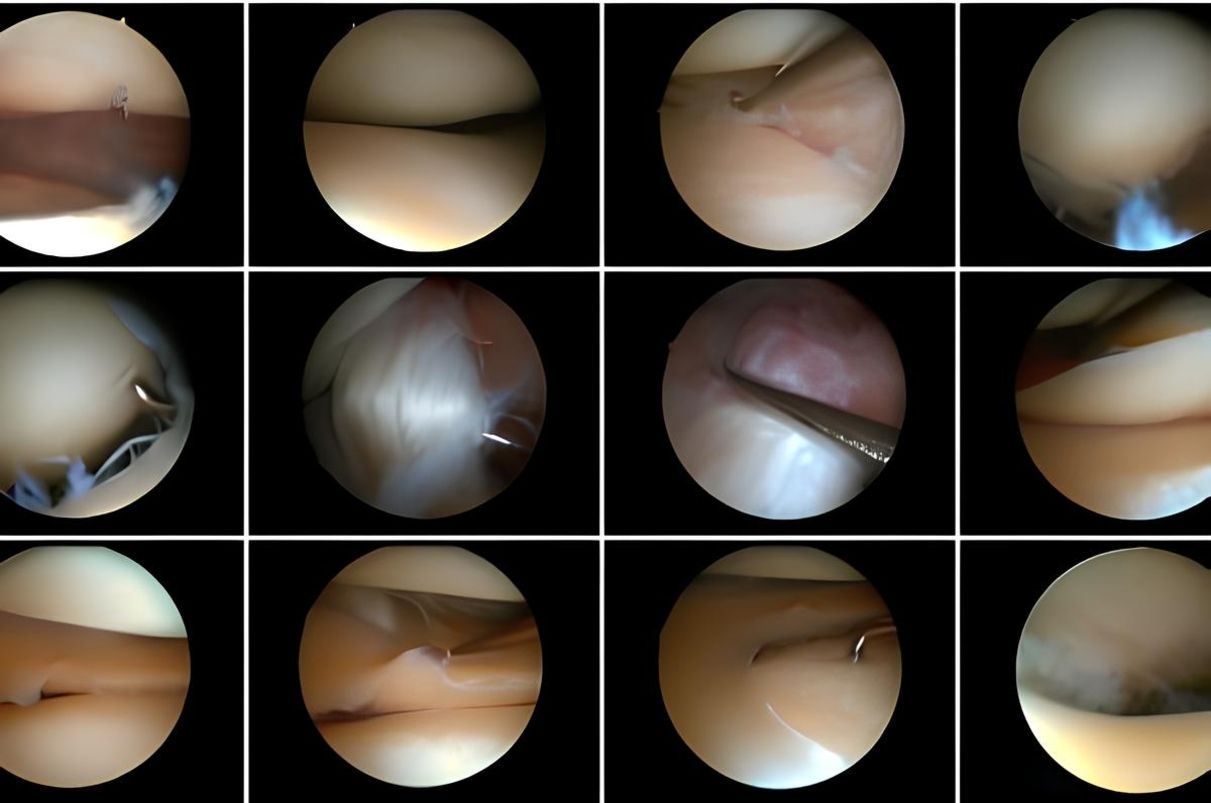 Arthroskopie Knie - Orthopäde Stockerau (3) (1)